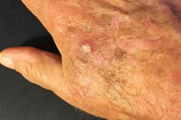 Image of Actinic keratoses Farnham on a person hand