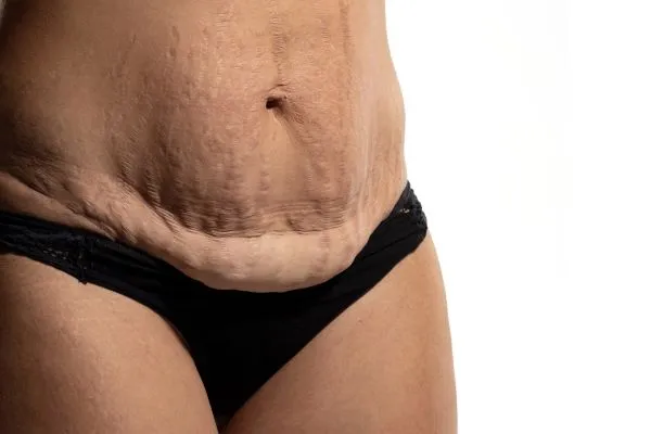 The science behind skin tightening Farnham picture of a woman's sagging skin on the stomach